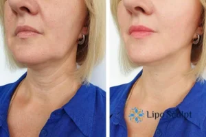 Double chin before and after Hi-Fu treatment 4 Book your double chin treatment Barton-le-Clay today! We are here to help!