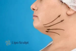 Double chin before and after Hi-Fu treatment 3 Boost your confidence with a Double chin treatment Barton-le-Clay