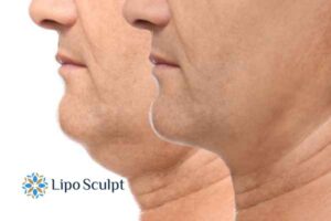 Double chin before and after Hi-Fu treatment 2 Double chin treatment Barton-le-Clay from Lipo Sculpt - feel more confident today!