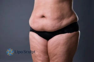Cellulite's 5 Most Common Causes 4 Feel more confidence with your cellulite Barton-le-Clay treatment today!