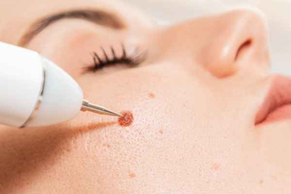 CryoPen: 5 Skin Concerns It May Be Used to Treat 3 What actually happens during a CryoPen treatment Barton-le-Clay?