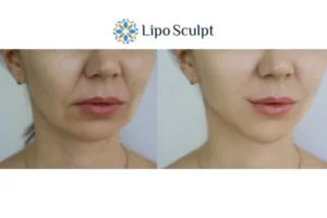 Explaining Morpheus8 And What It Can Do For You 2 Do you want to boost your self confidence? Give Morpheus8 Barton-le-Clay a try today!