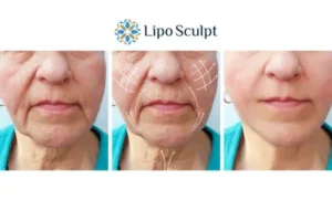 Explaining Morpheus8 And What It Can Do For You 3 Boost your confidence with Morpheus8 Barton-le-Clay call our team today!