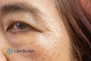 Cryopen: The Revolutionary Treatment for Age Spots Unveiled 2 Are age spots Barton-le-Clay giving you low self esteem? Contact us today!