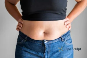 Bidding Farewell to Muffin Tops with Aqualyx Fat Injections 2 Do you wish you could reduce your muffin top Barton-le-Clay With Aqualy fat dissolving injections you can!