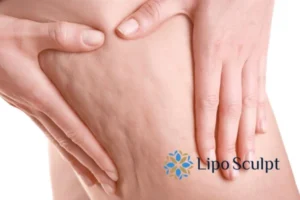 CoolSculpting for Legs: The Innovative Approach to Redefining Your Legs 5 Start your journey today book your coolsculpting treatment Barton-le-Clay online today!